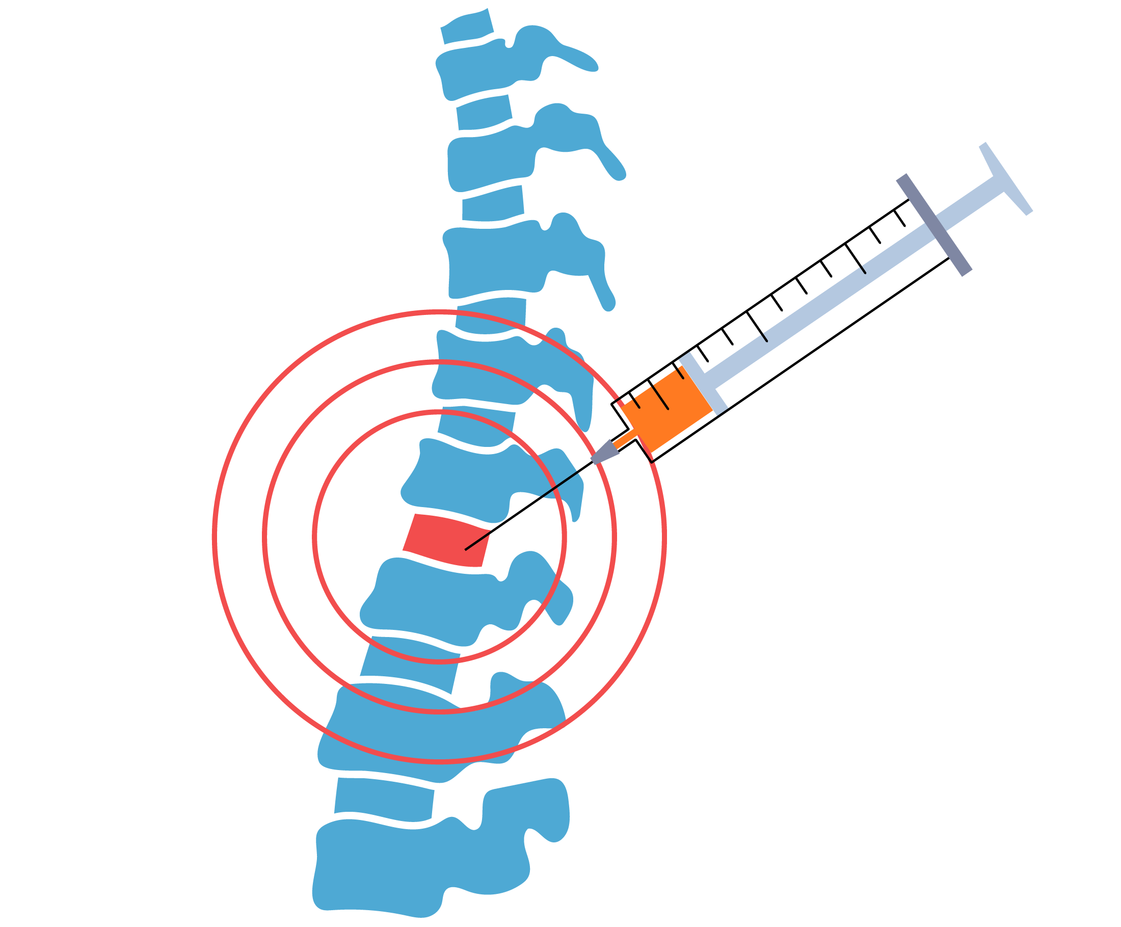 Steroid Injections - Golden State Orthobiologics